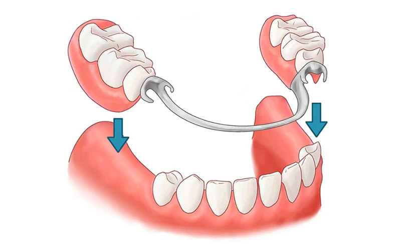 Estetica Dental Protesis en Tenerife